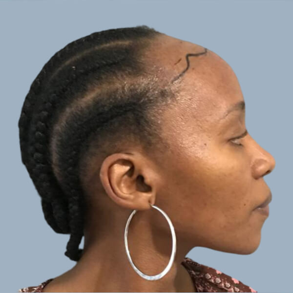 African hair transplant African hair transplant surgery in Cape Town