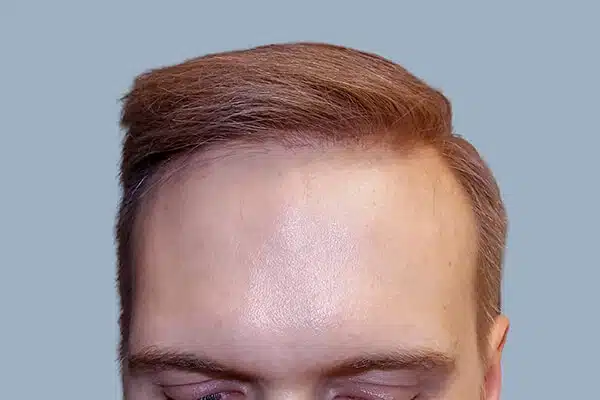 After hair transplant A