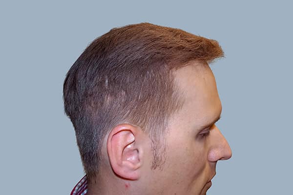 After hair transplant B