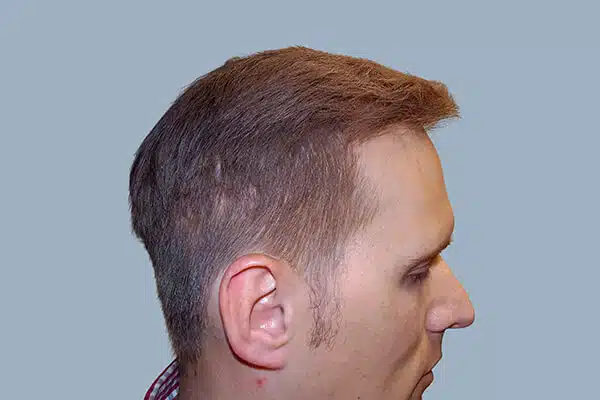 After hair transplant B