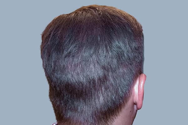 After hair transplant C