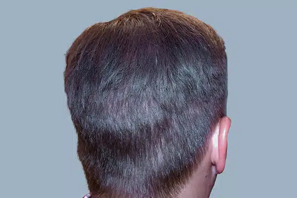 After hair transplant C