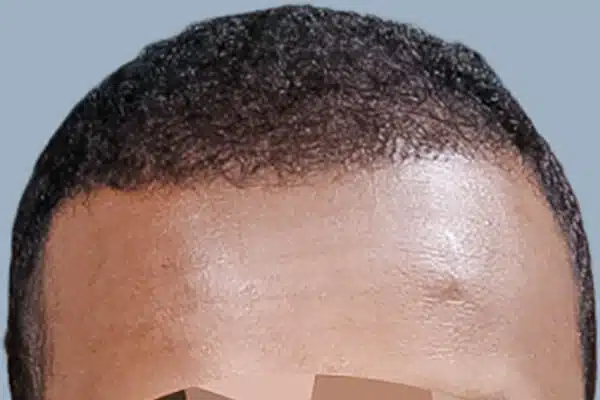 After hair transplant
