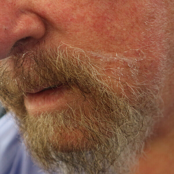 Beard hair transplant cape town dr janekelowitz