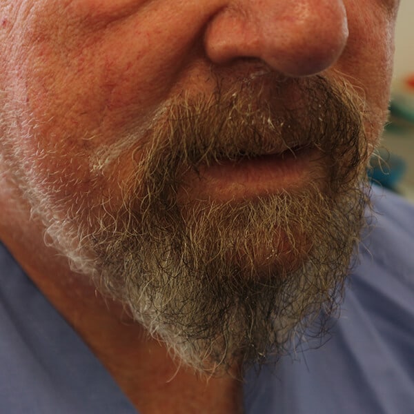 Beard transplant cape town