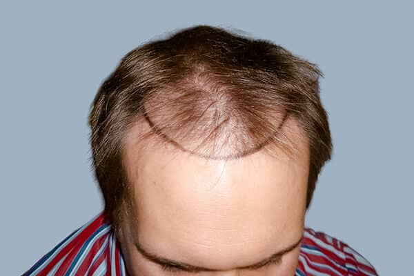 Before hair transplant A