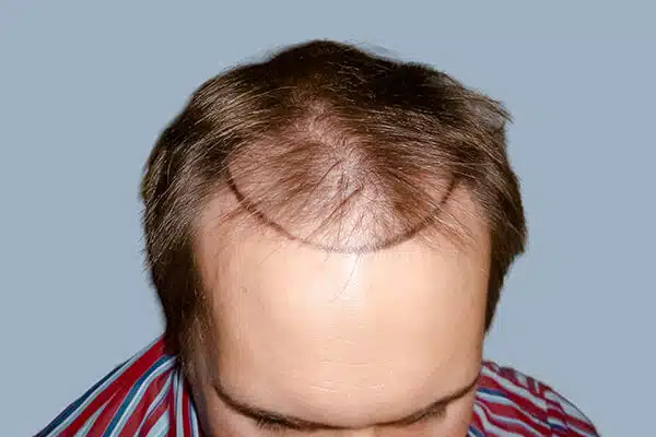 Before hair transplant A