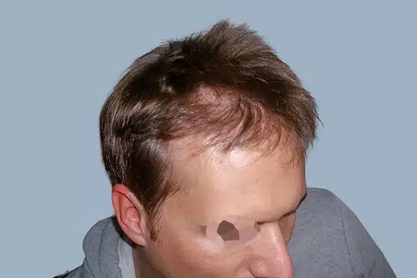 Before hair transplant B