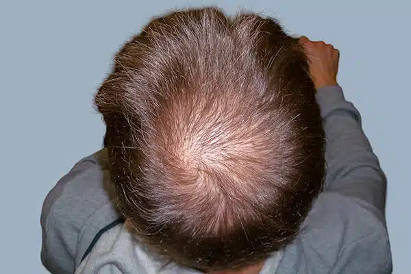 Before hair transplant