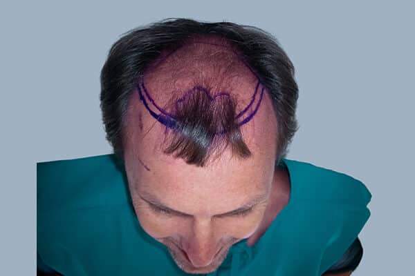 Before hair transplant surgery