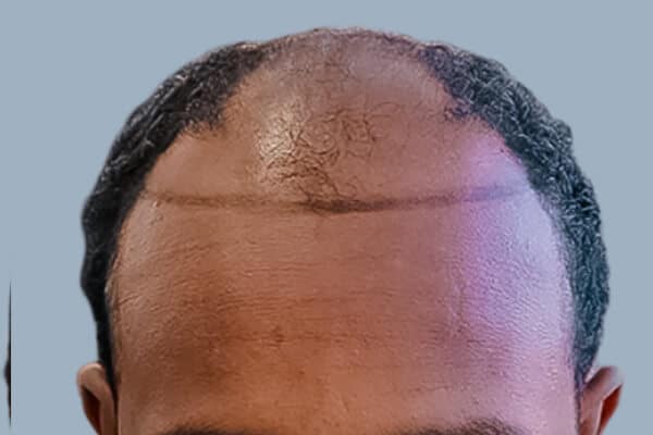 Before hair transplant