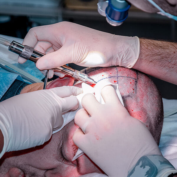 hair transplant surgery