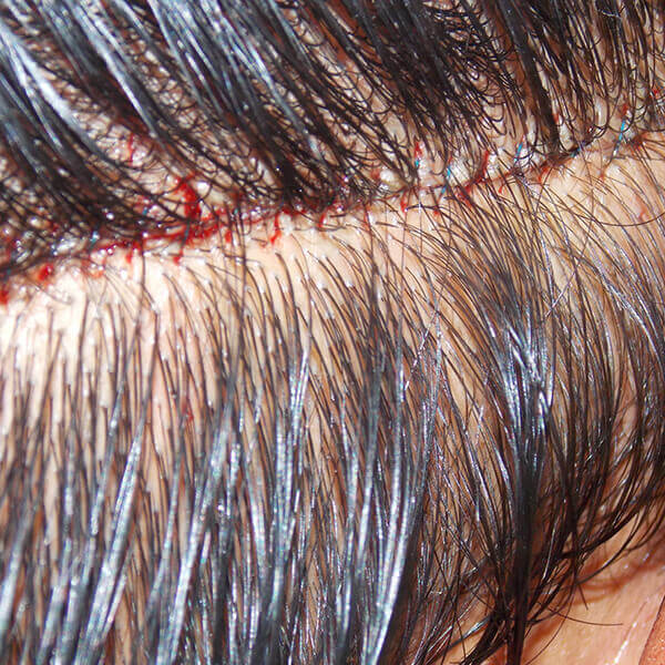 FUT hair transplant surgery