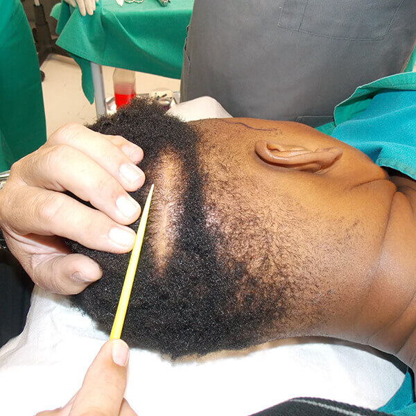 FUT hair transplant surgery Cape Town Dr Ryan Jankelowitz in Cape Town performing FUT hair transplant surgery