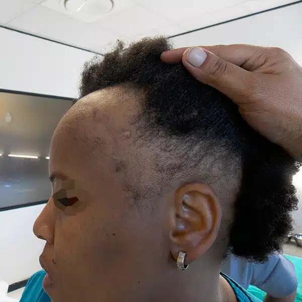 Female hair transplant african