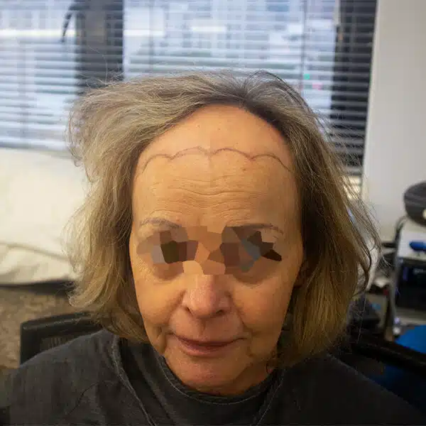 Female hair transplant caucasian