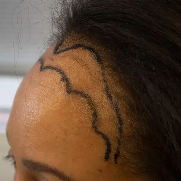 Female hair transplant ethnic