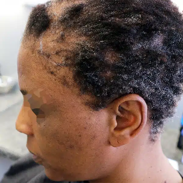 Female hair transplant surgery african