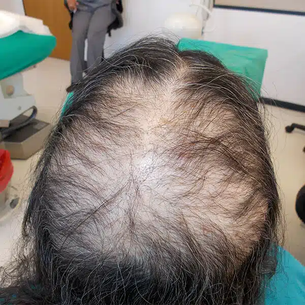 Female hair transplant surgery caucasian cape town