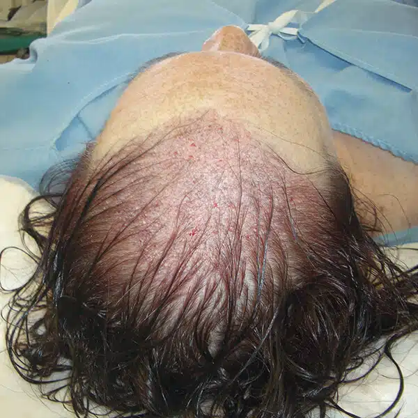 Female hair transplant surgery caucasian