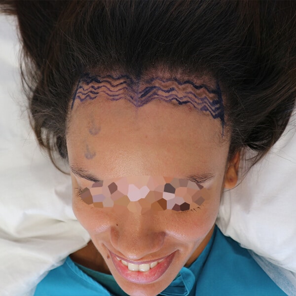 Forehead lowering surgery south africa