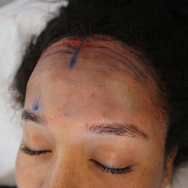 Forehead reduction surgery