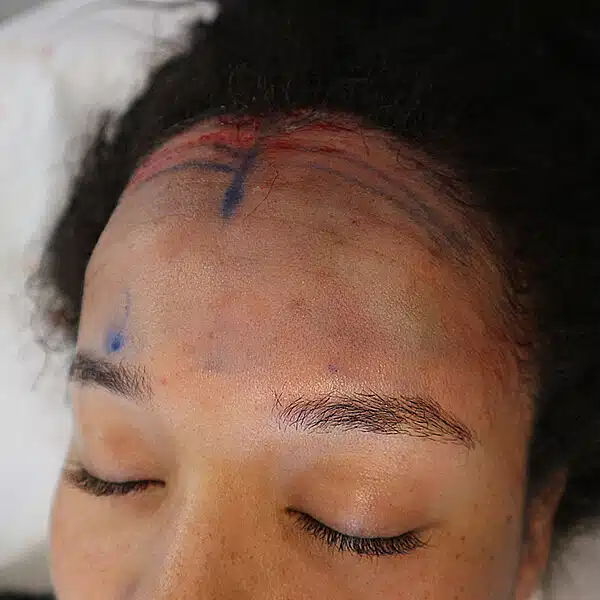 Forehead reduction surgery