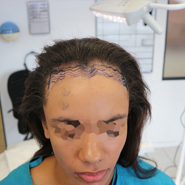 Forehead reduction surgery cape town