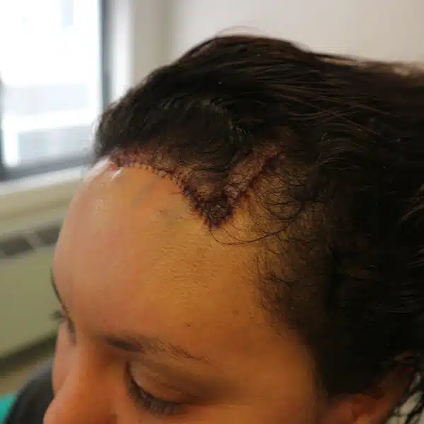 Forehead reduction surgery cape town south africa