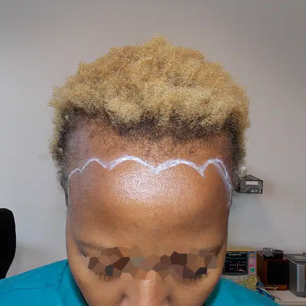 african hair transplant