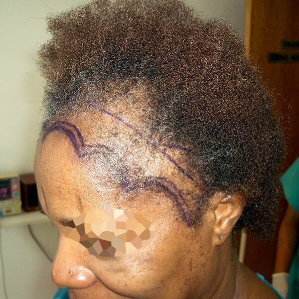 african hair transplant surgery