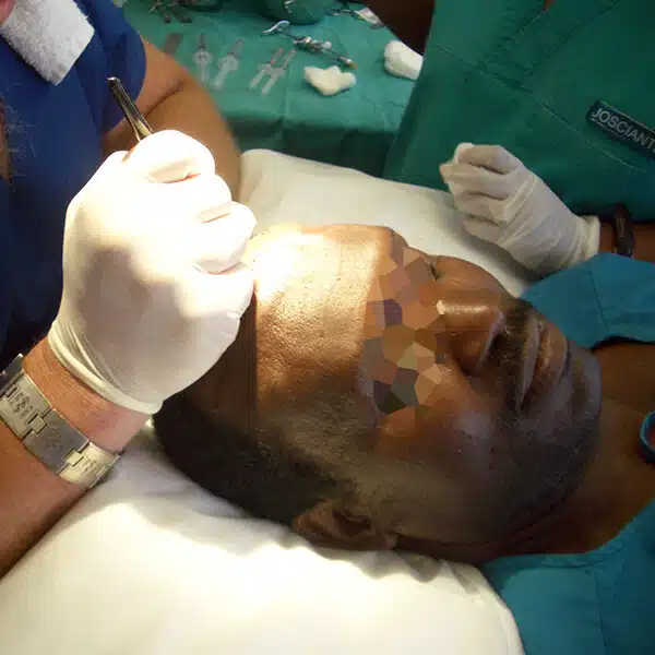 african male hair transplant cape town