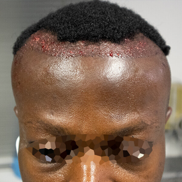 african male hair transplant