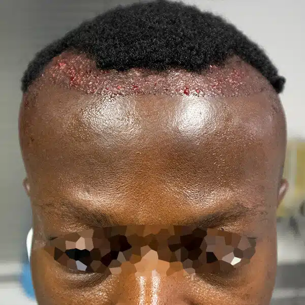 african male hair transplant