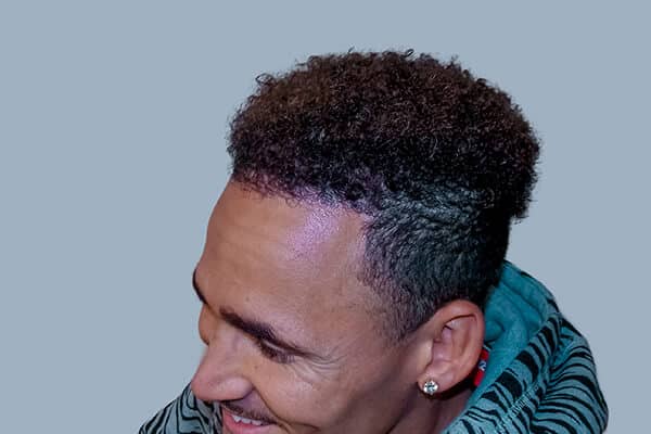 after hair transplant