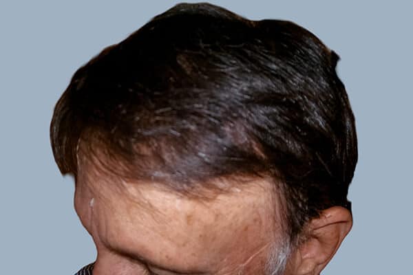 after hair transplant