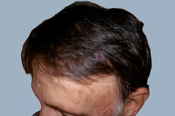 after hair transplant