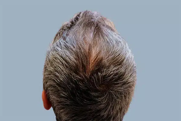after hair transplant