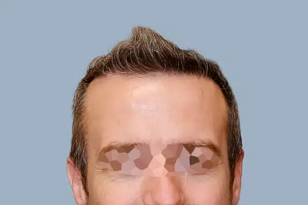 after hair transplant B