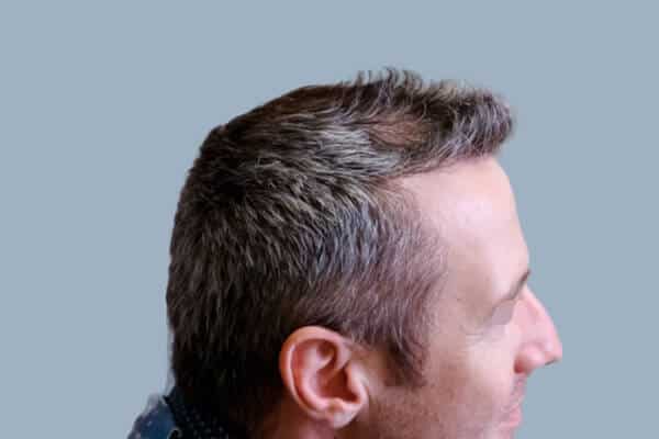 after hair transplant C