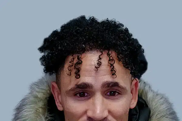 after hair transplant b