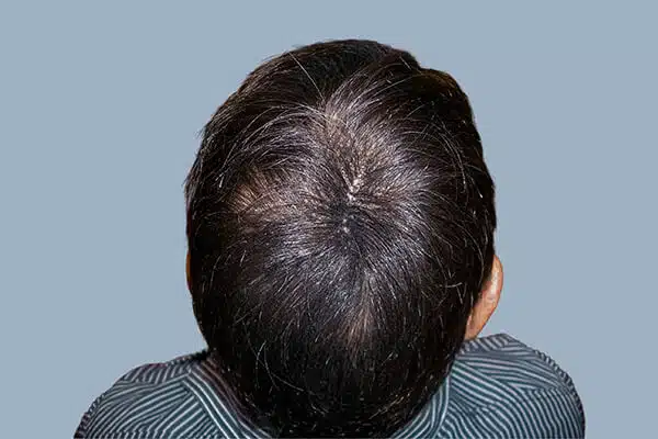 after hair transplant b