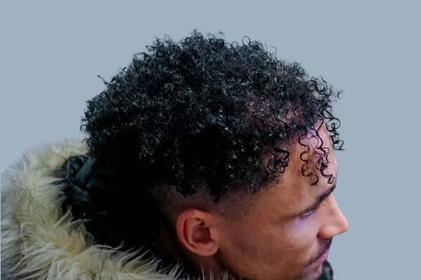 after hair transplant c