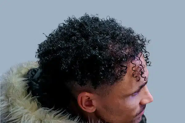 after hair transplant c