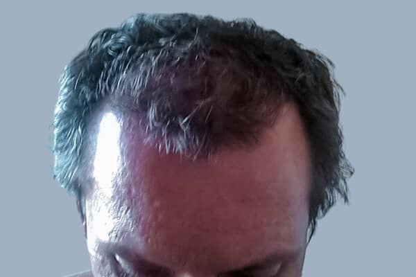 after hair transplant surgery