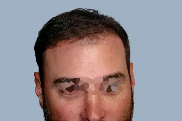 after hair transplant surgery