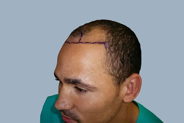 before hair transplant