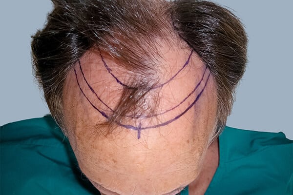 before hair transplant