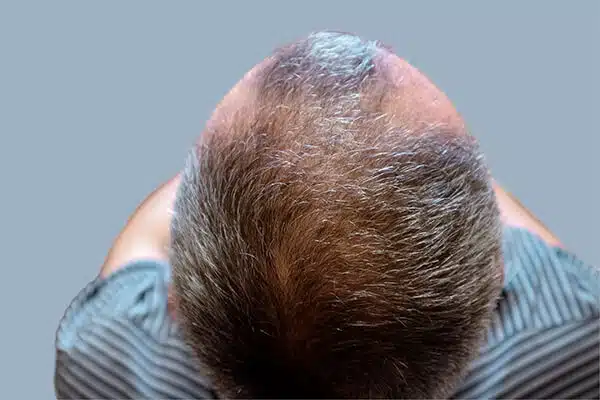 before hair transplant A