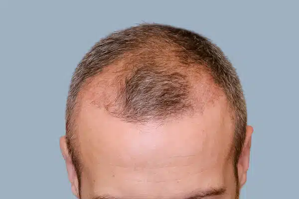 before hair transplant